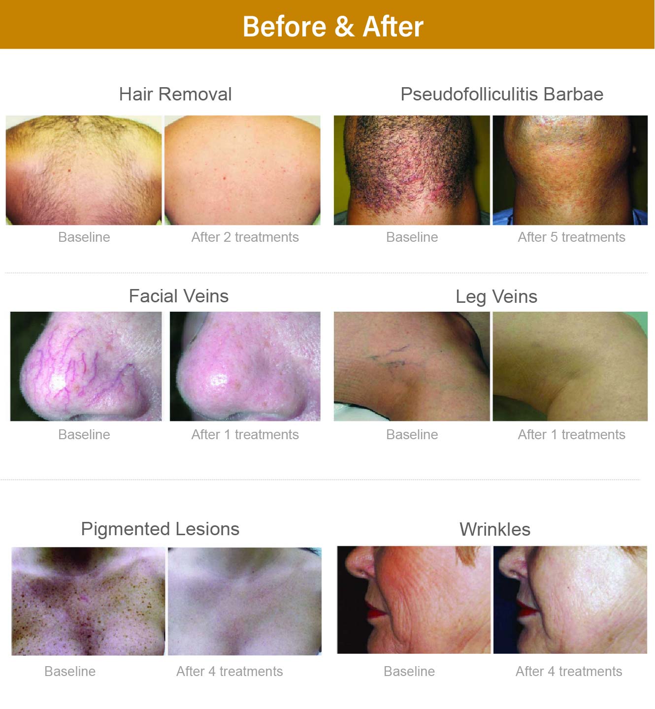 alexandrite laser treatment comparison