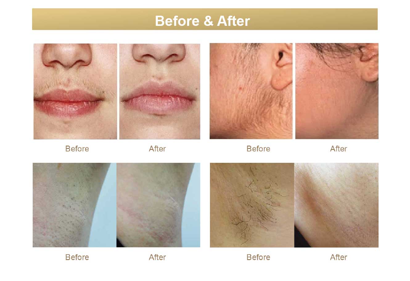 hair removal comparison