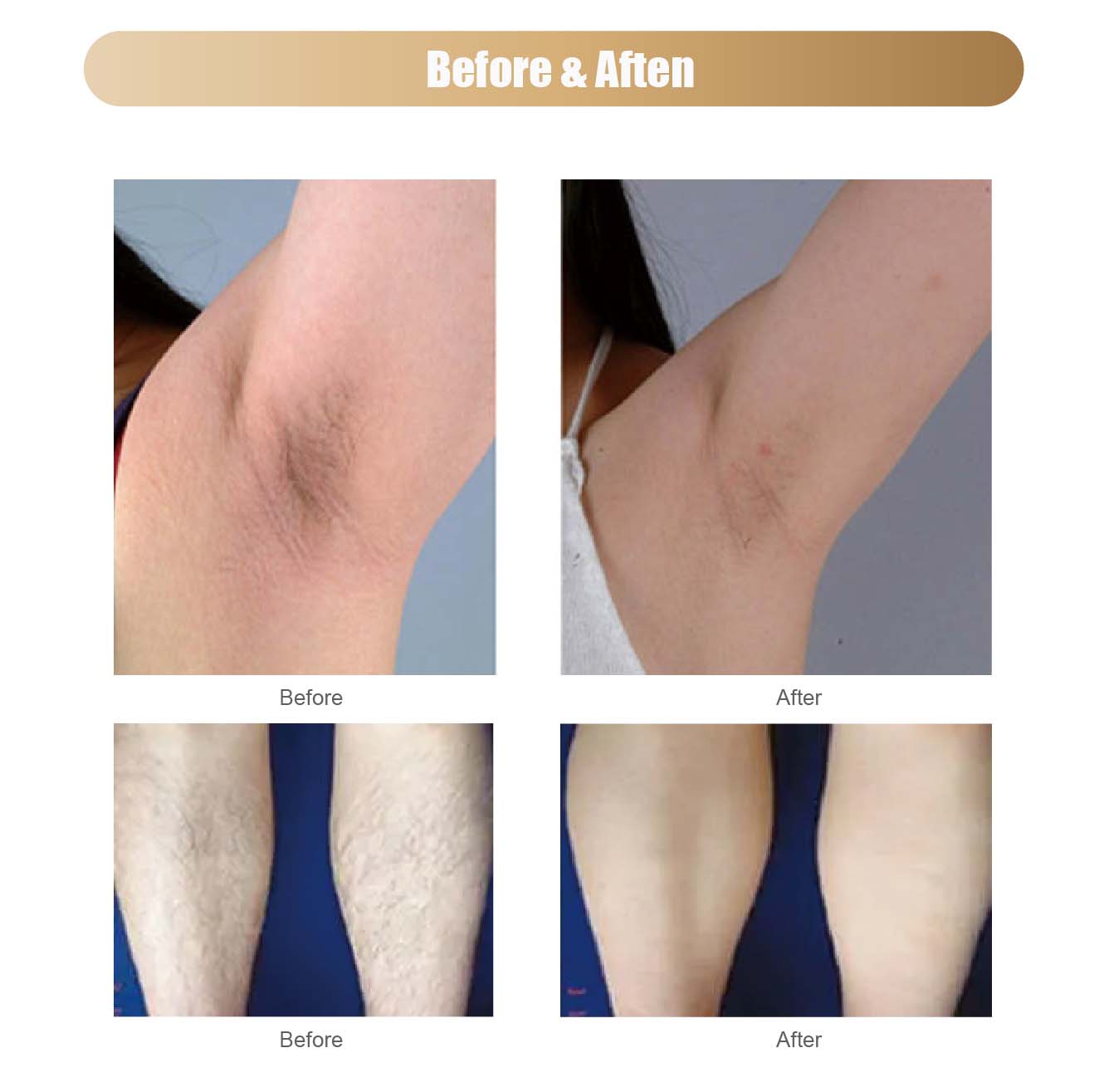 hair removal treatment