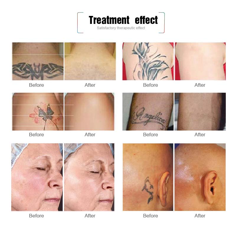 ND yag laser treatment effect