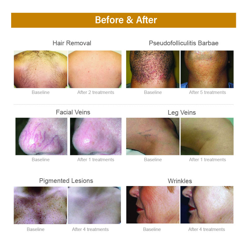 alexandrite laser treatment