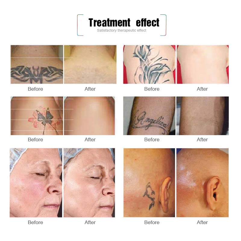 picosecond laser treatment